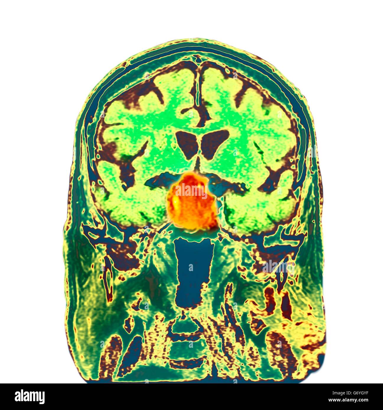 Hypophyse Tumor. Farbige berechnet Computertomographie (CT) Untersuchung des einen Schnitt durch das Gehirn eine 84 Jahre alten männlichen Patienten mit einem Tumor (Runde, Mitte) Auswirkungen auf die Hypophyse. Hypophyse-Tumoren sind in der Regel Adenome - gutartig (nicht krebsartige) Tumoren ari Stockfoto