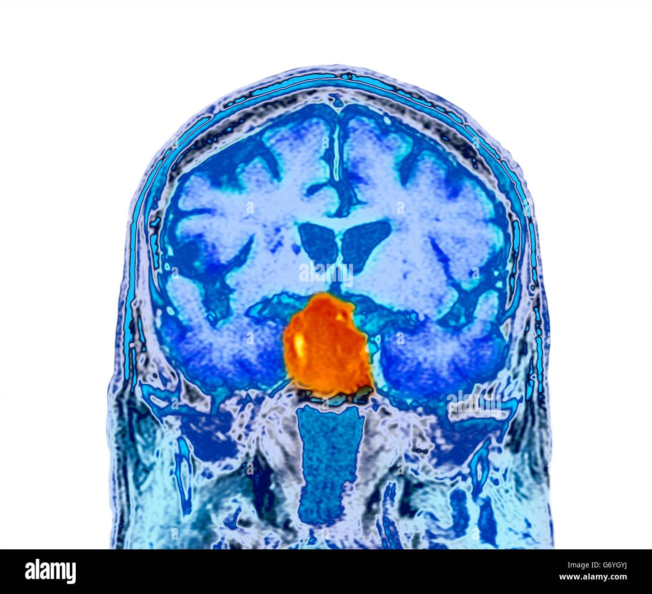 Hypophyse Tumor. Farbige berechnet Computertomographie (CT) Untersuchung des einen Schnitt durch das Gehirn eine 84 Jahre alten männlichen Patienten mit einem Tumor (Runde, Mitte) Auswirkungen auf die Hypophyse. Hypophyse-Tumoren sind in der Regel Adenome - gutartig (nicht krebsartige) Tumoren ari Stockfoto