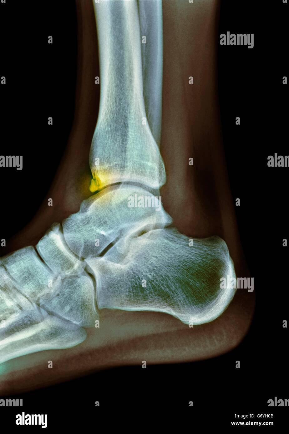 Tibiale Sporn. Farbige Röntgen des Fußes eines 22 Jahre alten männlichen Patienten mit einem Sporn (Osteophyten, hervorgehoben) beeinflussen die Tibia (Schienbein). Knochen spornt Knochen-Projektionen, die an den Enden der Gelenke bilden. Verursacht werden sie durch Degeneration der Knochen, Alterung und Stockfoto