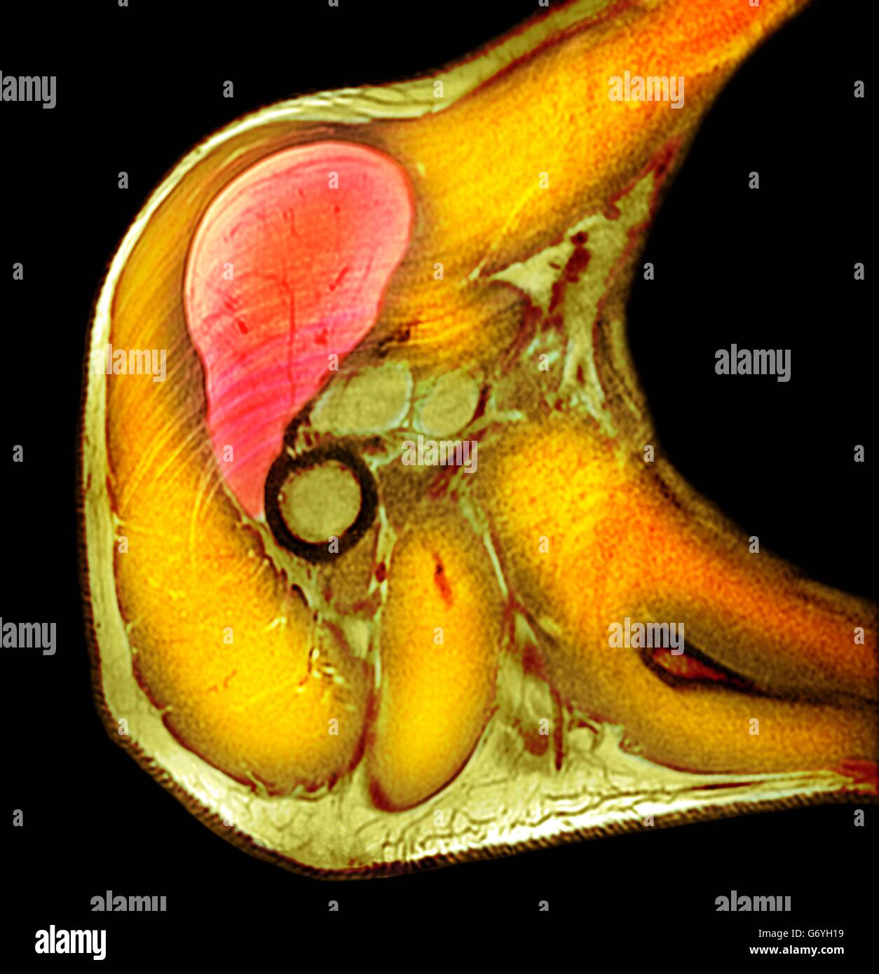 Lipom der Schulter. Farbig x-ray der Schulter von einem 58 Jahre alten männlichen Patienten zeigen ein großes Lipom. Lipome sind gutartig (nicht krebsartige) Tumoren entstehen aus Fettgewebe (Fett) Gewebe. Sie sind die häufigste Form von Weichgewebe Tumor. Stockfoto