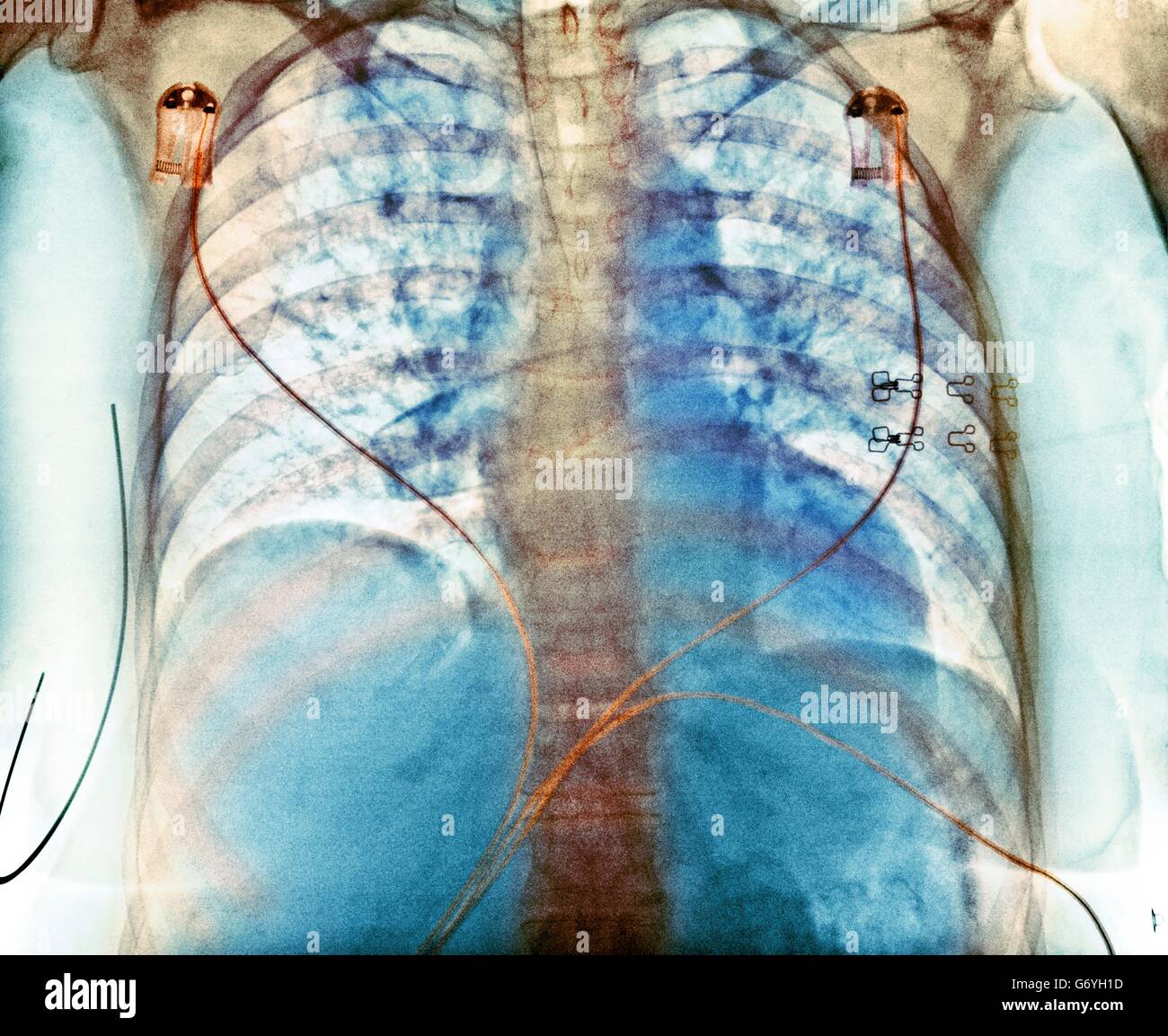Aspiration. Gefärbte Brust Röntgen zeigt Aspiration (dunkle Bereiche) in der Lunge einer 76 jährige Patientin mit einer umfangreichen Hirnblutung. Aspiration ist die Inhalation von Fremdstoffen, wie z. B. gastrischen Inhalt. Es ist häufig bei Patienten mit Stockfoto