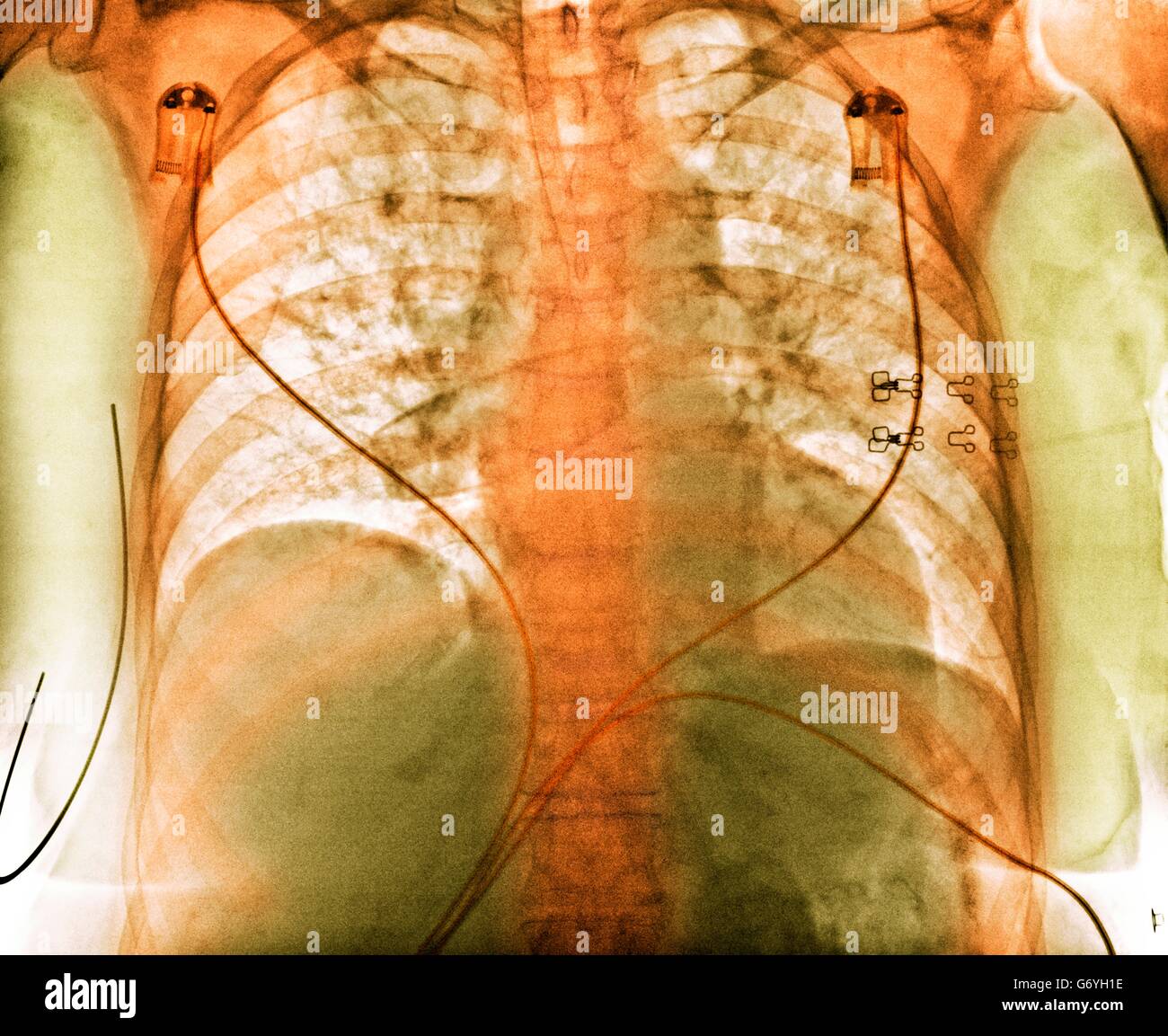 Aspiration. Gefärbte Brust Röntgen zeigt Aspiration (dunkle Bereiche) in der Lunge einer 76 jährige Patientin mit einer umfangreichen Hirnblutung. Aspiration ist die Inhalation von Fremdstoffen, wie z. B. gastrischen Inhalt. Es ist häufig bei Patienten mit Stockfoto