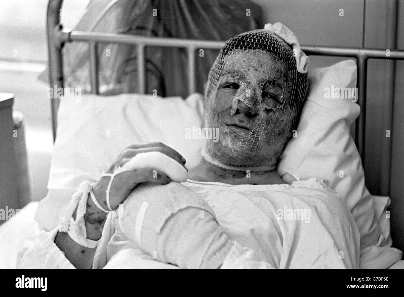 Gary Cowan, 16, aus St. Helens, in einem Krankenhaus in Birmingham nach dem Bombenanschlag auf die Taverne im Stadtpub. Stockfoto