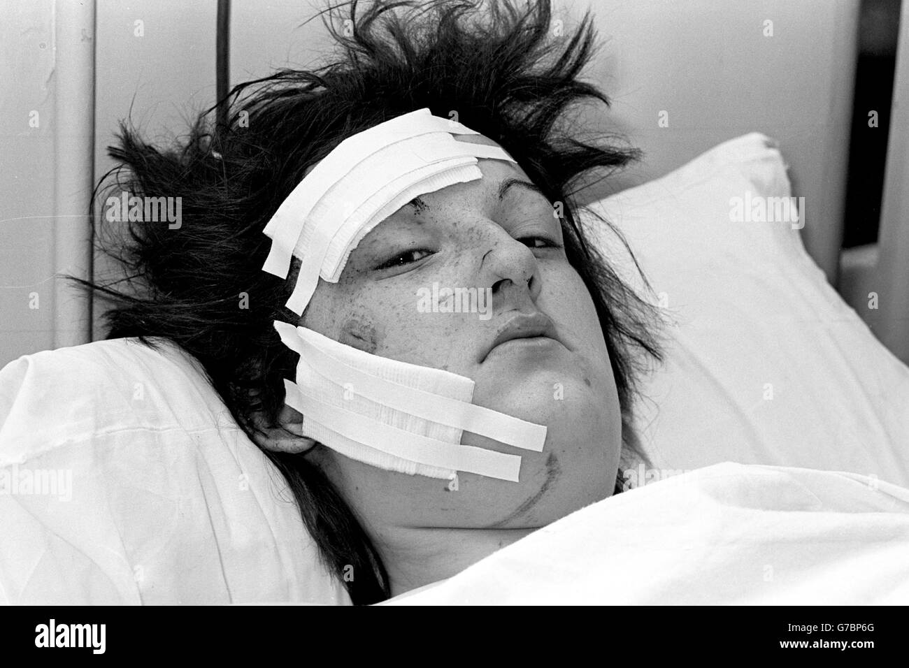 Barbara Lane, 21, eines der Opfer des Bombenanschlags auf die Taverne im Stadtpub. Sie wird im Birmingham General Hospital behandelt. Stockfoto