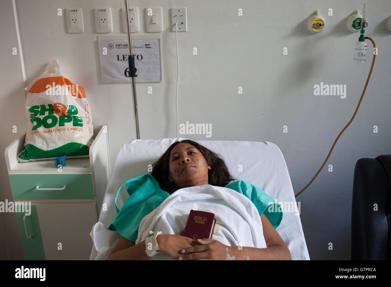 Die Erwachsene Frau, die in die Fundação de Medicina Tropical do Amazonas in Manaus, Brasilien, aufgenommen wurde, weist den charakteristischen Masern-Ausschlag auf – rote makulopapulöse Flecken, die im Gesicht beginnen und sich über den Körper ausbreiten. Diese hoch ansteckende, durch die Luft übertragene Virusinfektion unterstreicht die entscheidende Notwendigkeit einer robusten Impfversorgung und verstärkter Maßnahmen im Bereich der öffentlichen Gesundheit im Amazonasgebiet. Stockfoto