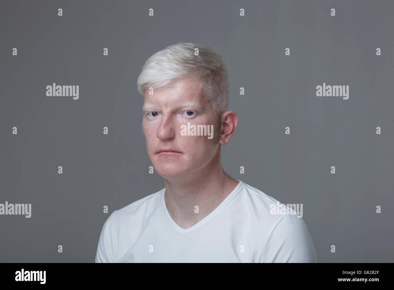 Porträt des Albino Menschen gegen den grauen Hintergrund Stockfoto