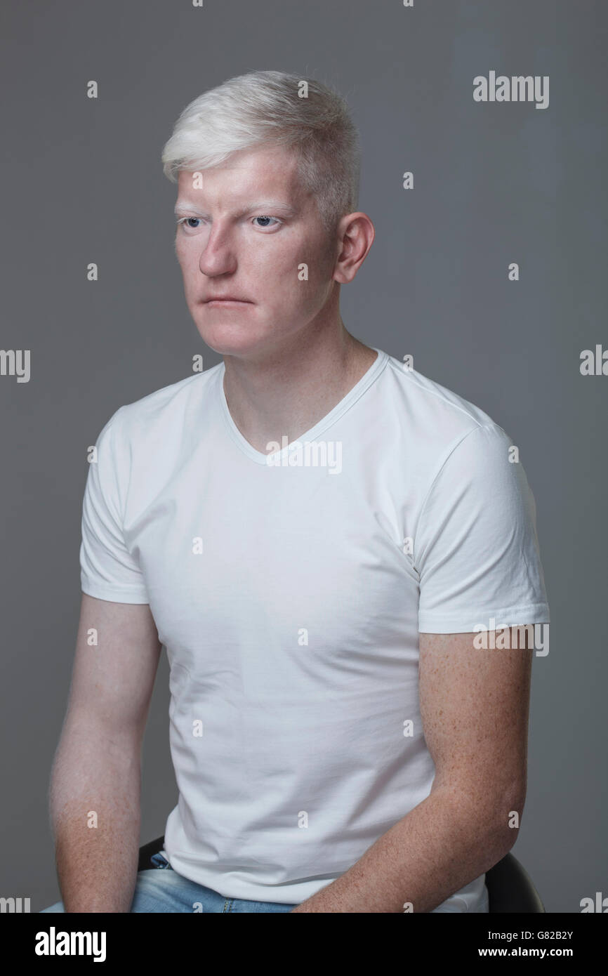 Junge Albino Mann sitzt vor grauem Hintergrund Stockfoto
