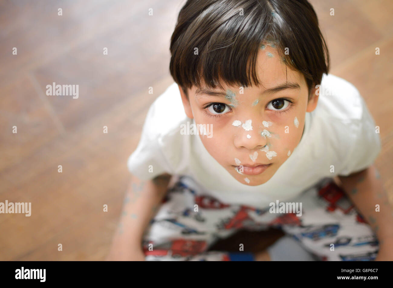 Kind mit hautausschlag -Fotos und -Bildmaterial in hoher Auflösung – Alamy