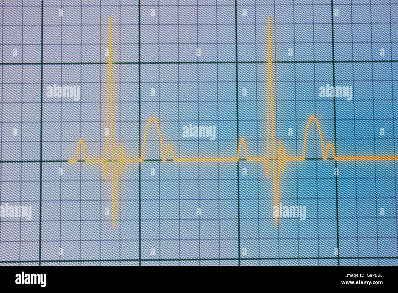 Flatline Ausrutscher auf einer medizinischen Herzmonitor ECG / EKG (Elektrokardiogramm) mit blauem Hintergrund Stockfoto