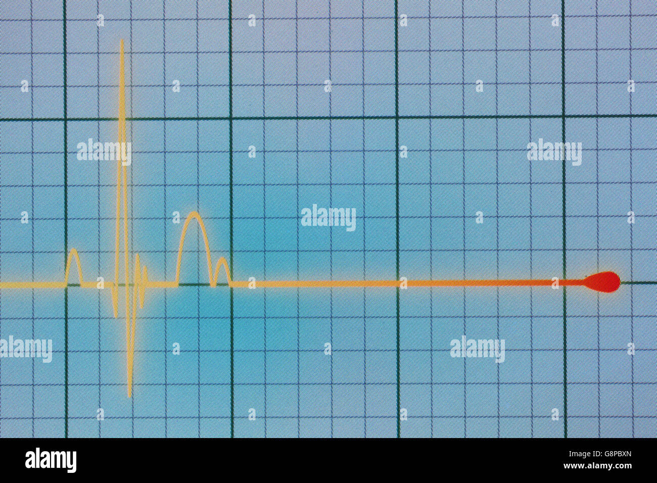 Flatline Ausrutscher auf einer medizinischen Herzmonitor ECG / EKG (Elektrokardiogramm) mit blauem Hintergrund Stockfoto
