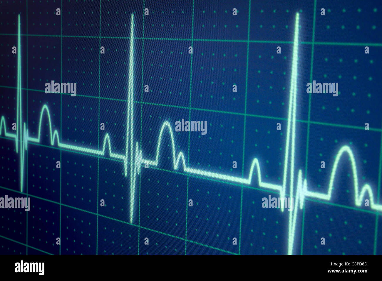 Flatline Ausrutscher auf einer medizinischen Herzmonitor ECG / EKG (Elektrokardiogramm) mit blauem Hintergrund Stockfoto