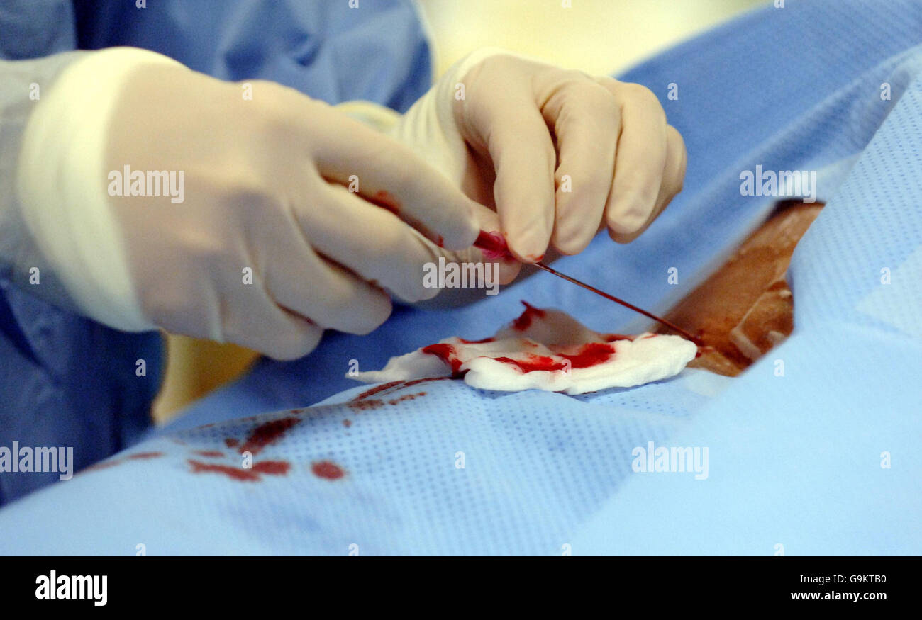 Generisches Stockbild. Ein Katheter wird nach einem Angiogrammverfahren im London Chest Hospital, November 20 2006, entfernt. London Chest Hospital. Stockfoto