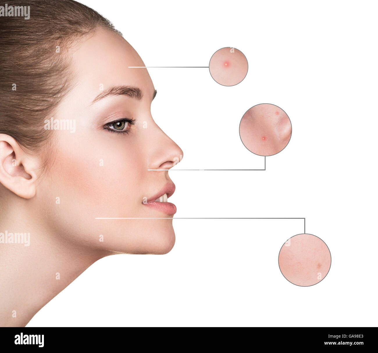 Weibliches Gesicht mit Zoom Kreisen isoliert auf weißem Hintergrund. Problem-Haut-Konzept. Stockfoto