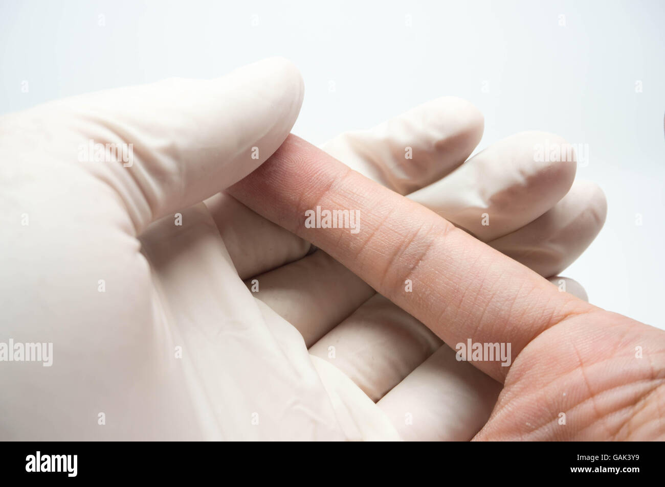 Arzt mit Prüfung Handschuh mit Verletzungen des Patienten finger Stockfoto