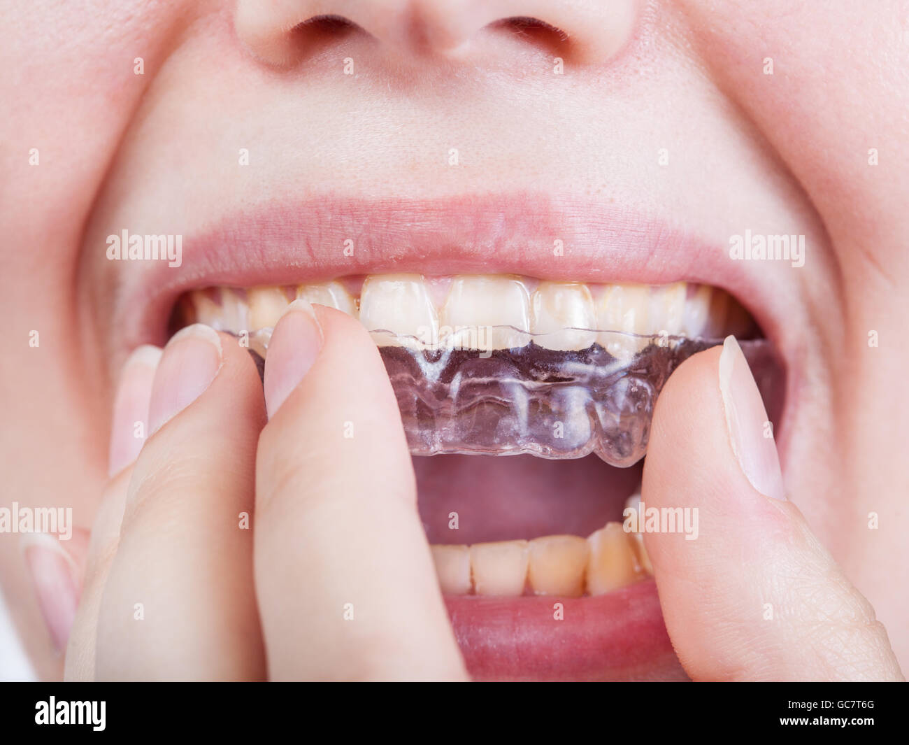 junge Frau legt clear-Aligner für kieferorthopädische Korrektur der Biss hautnah Stockfoto