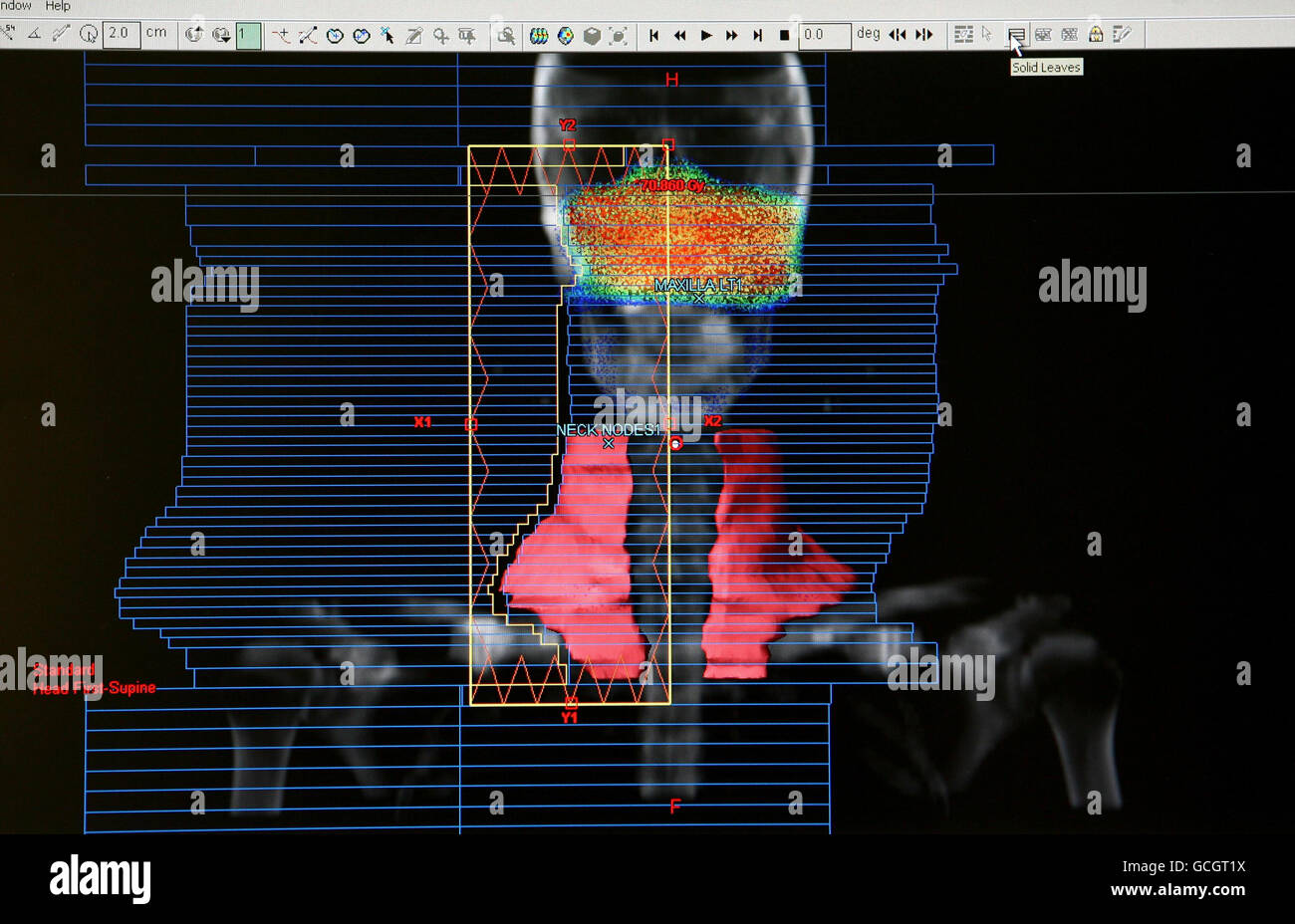 Ein computergestütztes Bild zeigt einen Tumor und seine anschließende Bestrahlung durch Strahlentherapie in der Strahlentherapieabteilung des Barts Hospital im Zentrum von London. Stockfoto