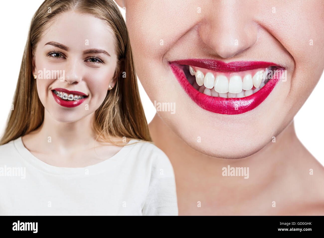 Perfekte Zähne vor und nach der geschweiften Klammern Stockfoto