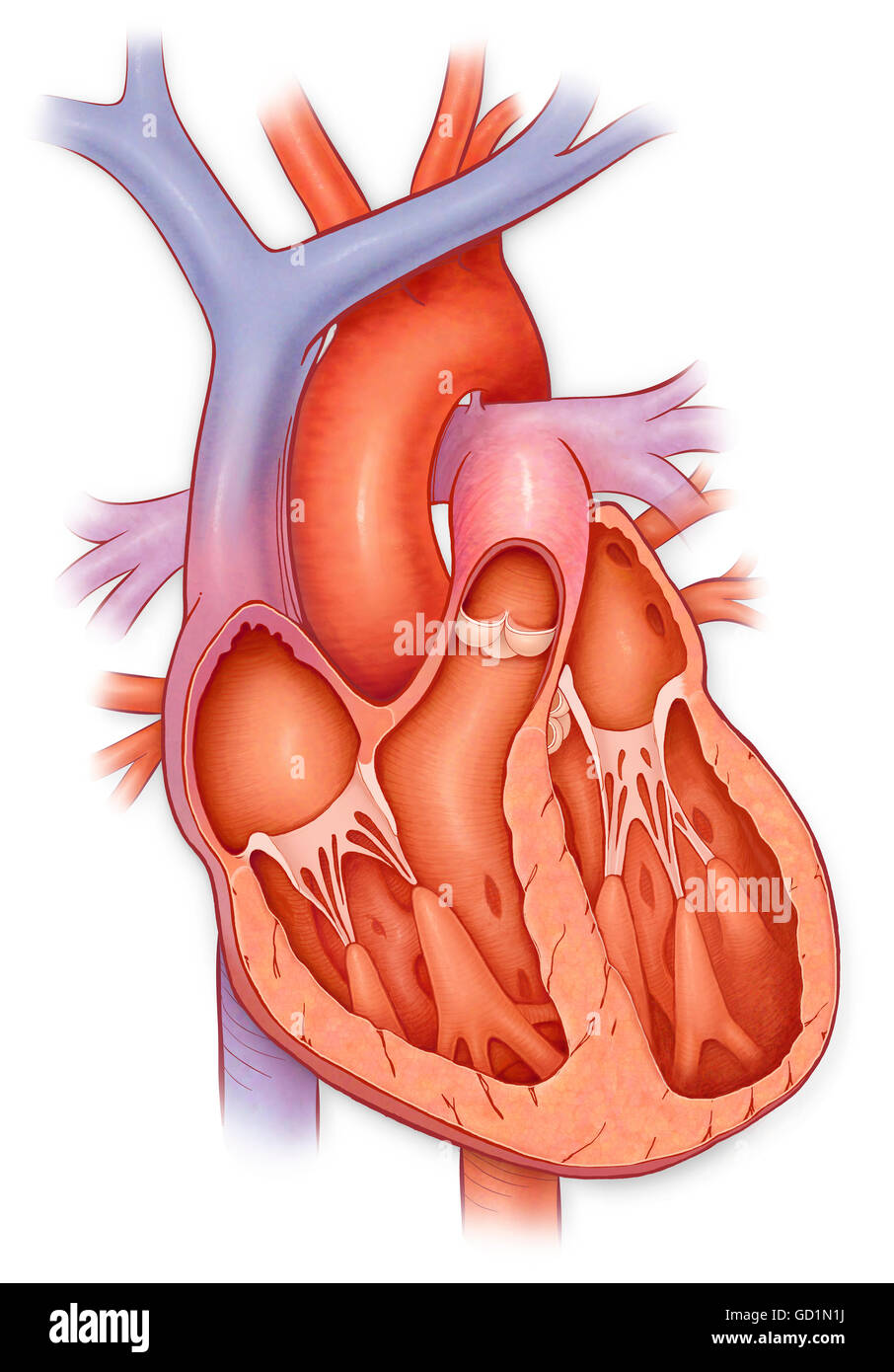 Querschnitt durch ein Herz mit einer erweiterten Ventrikel Stockfoto