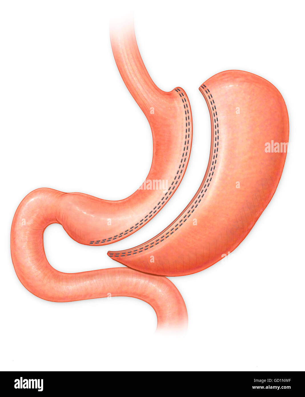 SleeveGastrektomie Verfahren Stockfoto, Bild 111291867 Alamy