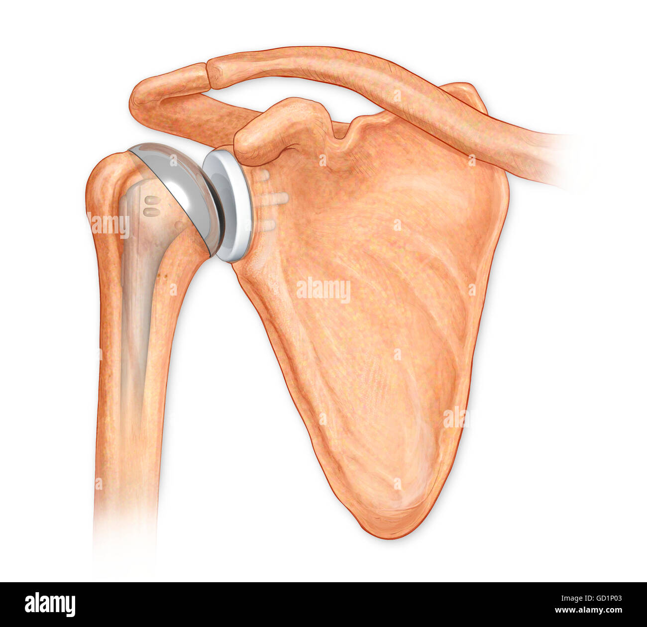 Ansicht von ventral total Schultergelenk reparieren Stockfoto