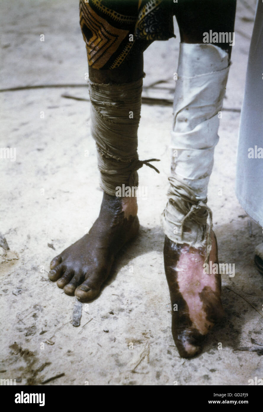 Medizin, Krankheiten, Lepra, Patient auf einer deutschen Leprastation in Afrika, 1962, Zusatzrechte-Clearences-nicht vorhanden Stockfoto