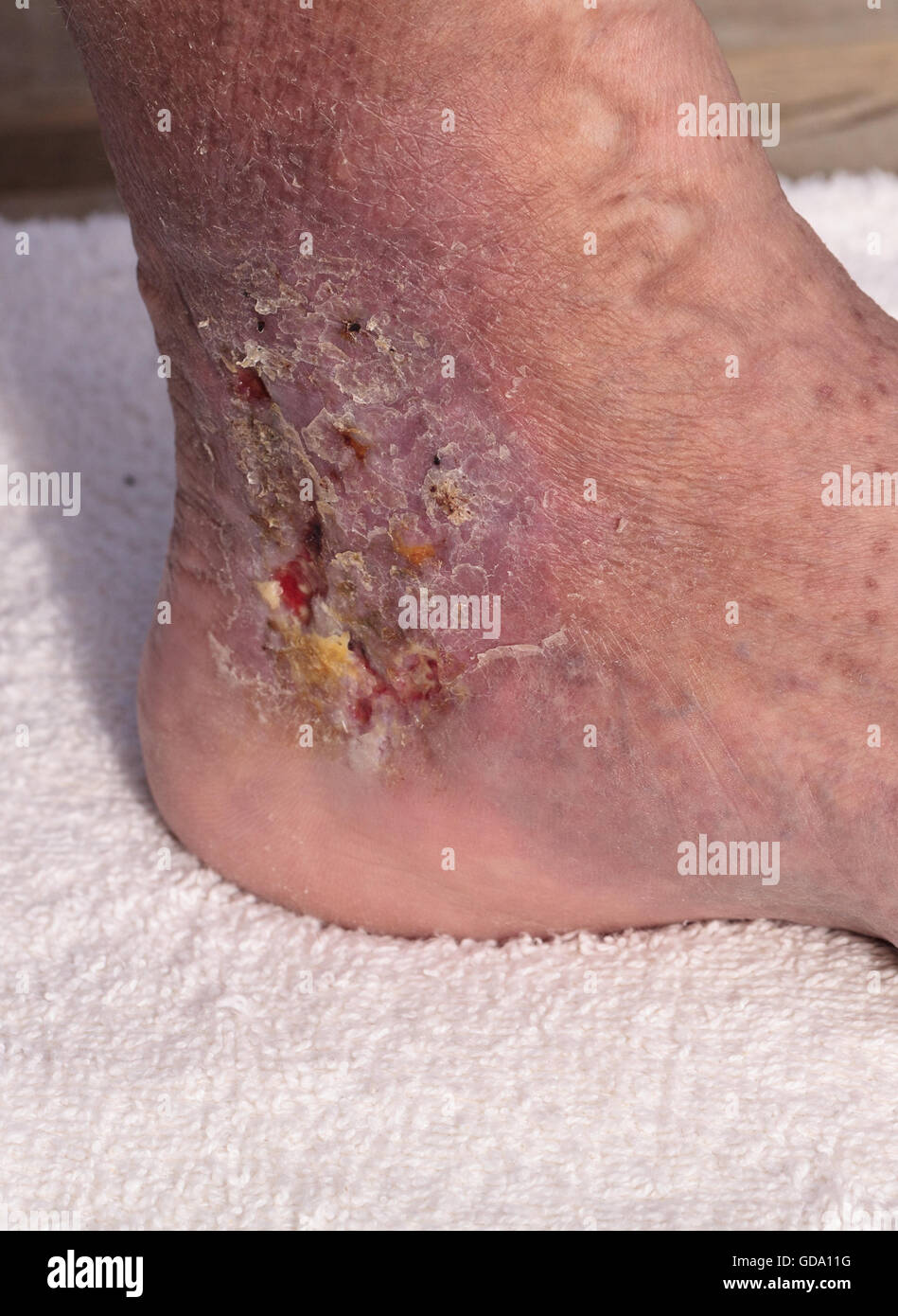 Medizinische Bild: Cellulitis Infektion auf der Haut einen Knöchel verursacht durch Venenentzündungen und Blutgerinnsel in den Venen. Stockfoto