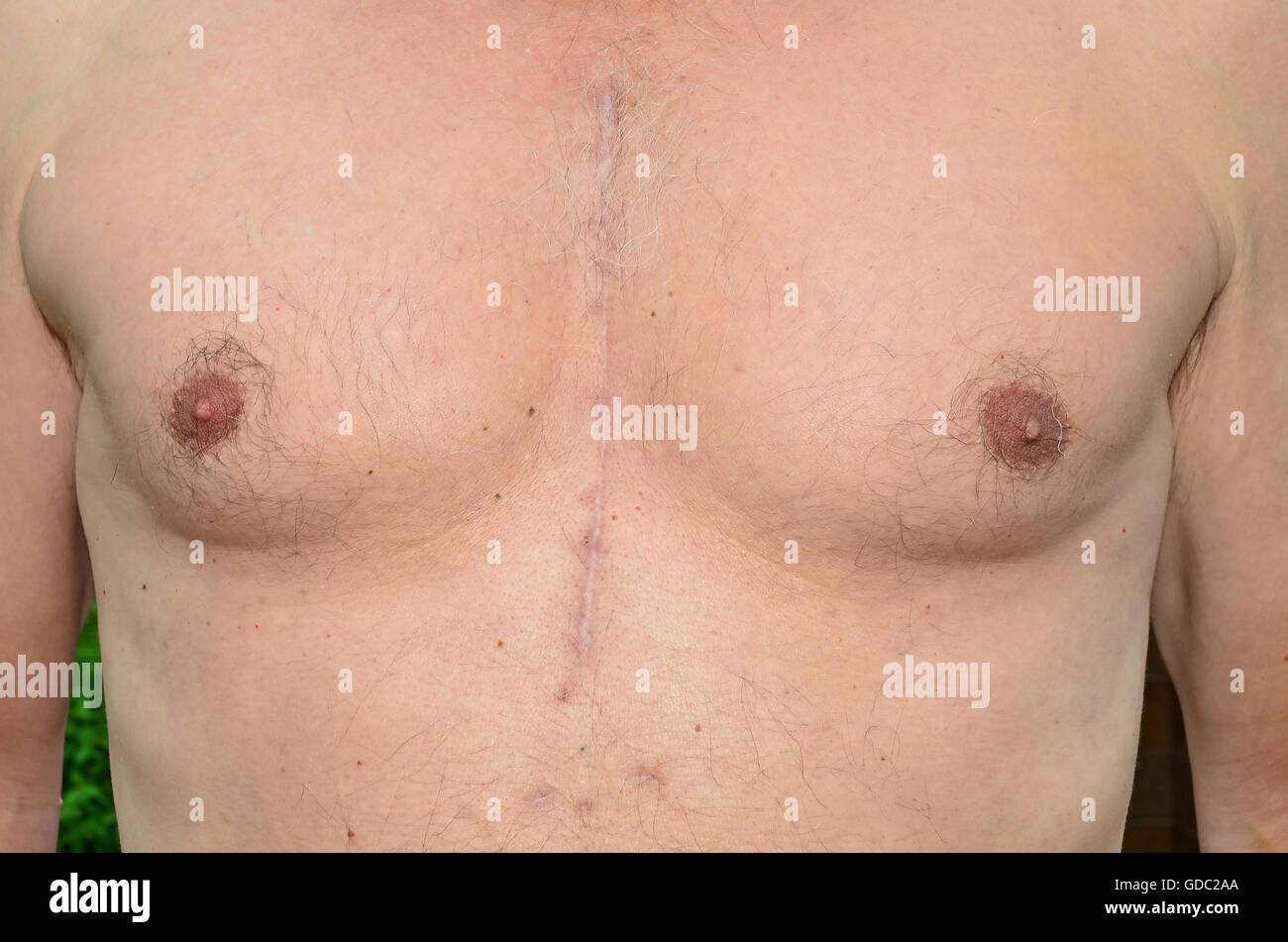 Brust eines Mannes, Operation am offenen Herzen 7 Monate zuvor erfahren hat, zeigt, wie die Narben verheilt sind. Stockfoto