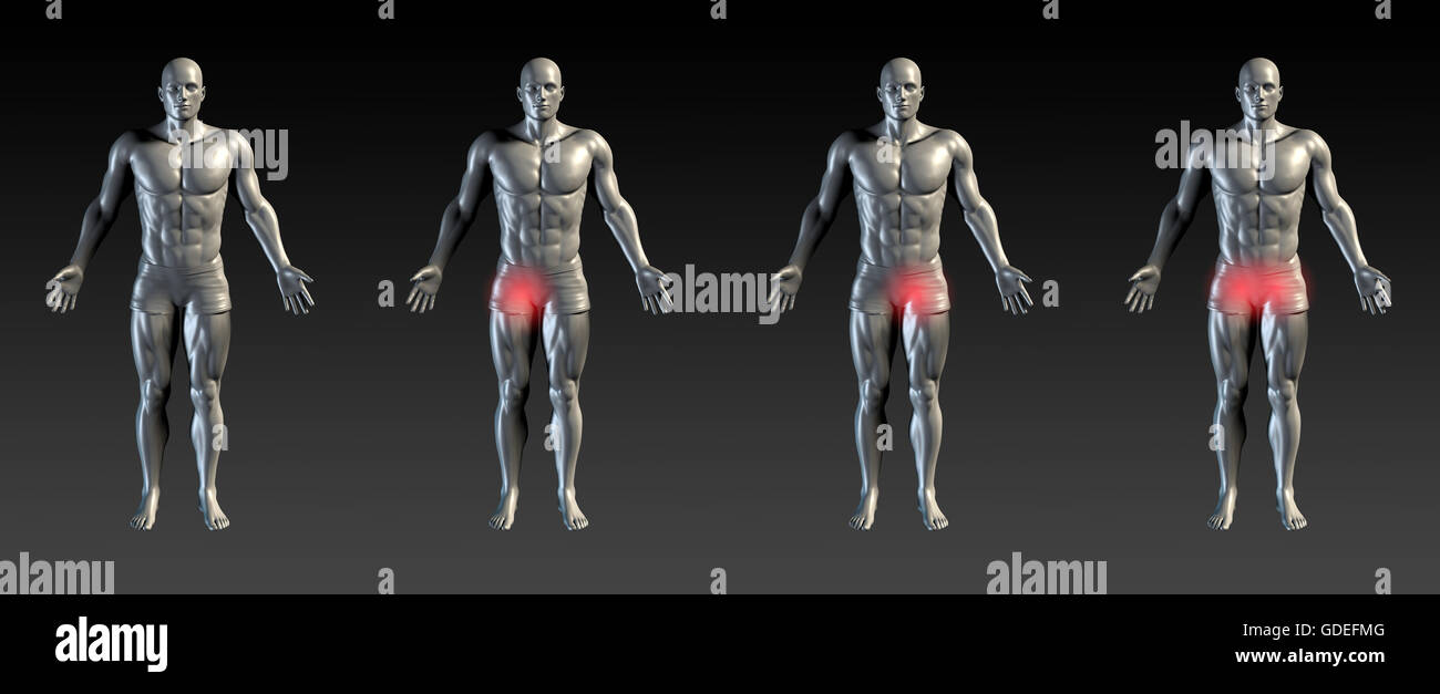 Leistenverletzung mit roten Schein auf Bereich Serie Stockfoto