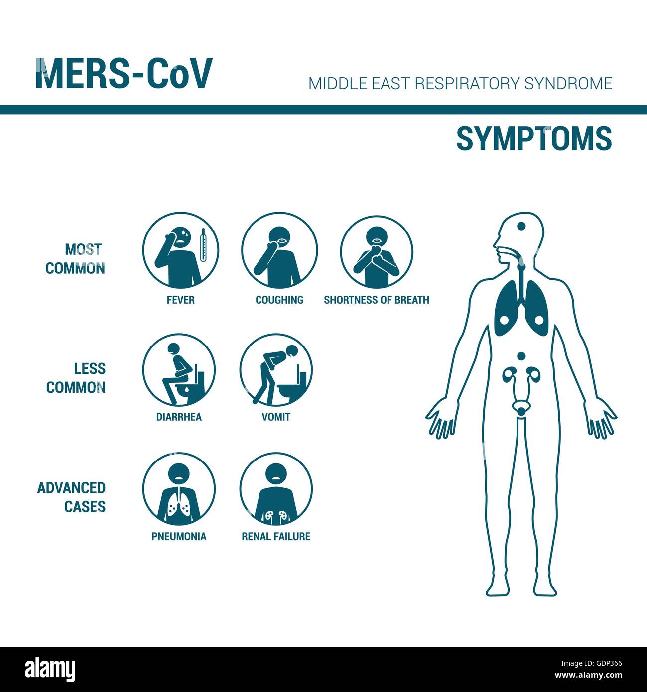 MERS CoV Symptome medizinischen Infografik mit Strichmännchen und dem menschlichen Körper Stock Vektor