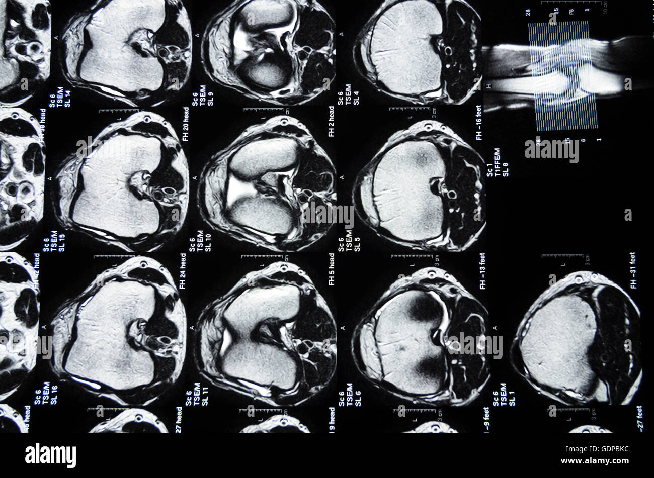 : Magnetresonanztomographie (MRT): Schnittbilder von einem Knie,,, Stockfoto