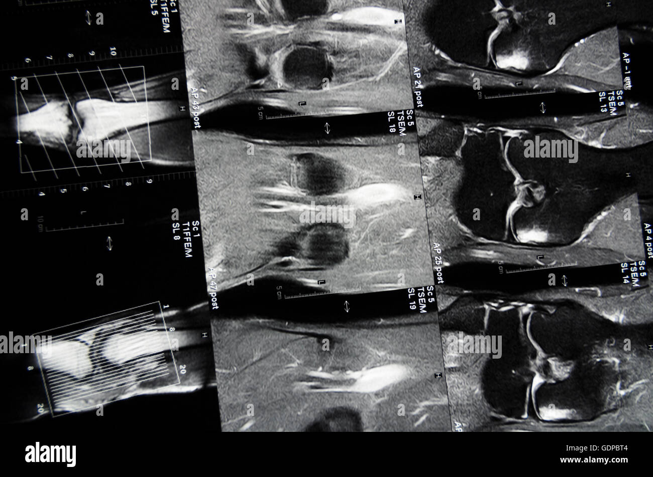 : Magnetresonanztomographie (MRT): Schnittbilder von einem Knie,,, Stockfoto