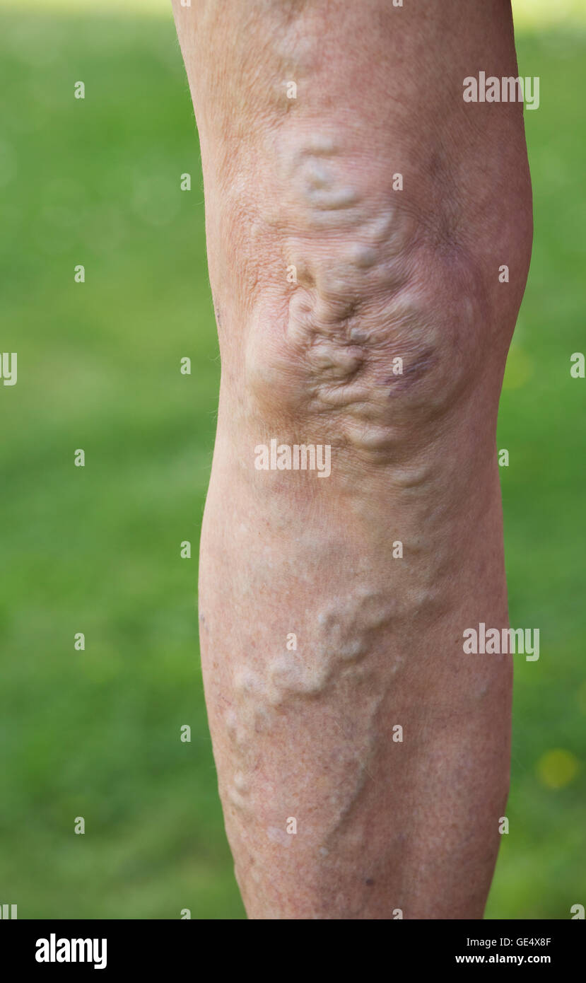 Krampfadern swollend erweiterten Venen und verzerrte Haut in die Knie und Beine der älteren Frau, Großbritannien Stockfoto