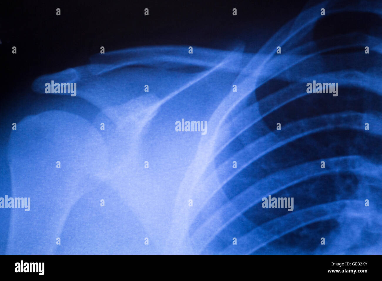 Schulter Gelenkverletzungen Xray Traumatologie und Orthopädie Test medizinische Untersuchung zur diagnose von Sportverletzungen bei Patienten eingesetzt. Stockfoto