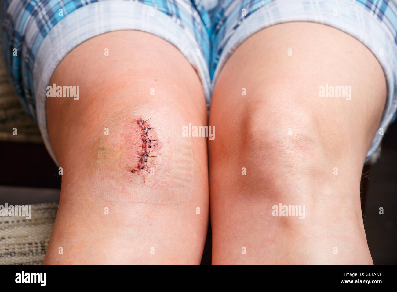 Narbe vom Betrieb mit einer schwarzen Faser Stockfoto