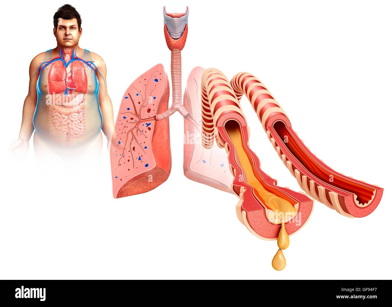 Darstellung der infizierten menschlichen Lunge Querschnitt. Stockfoto
