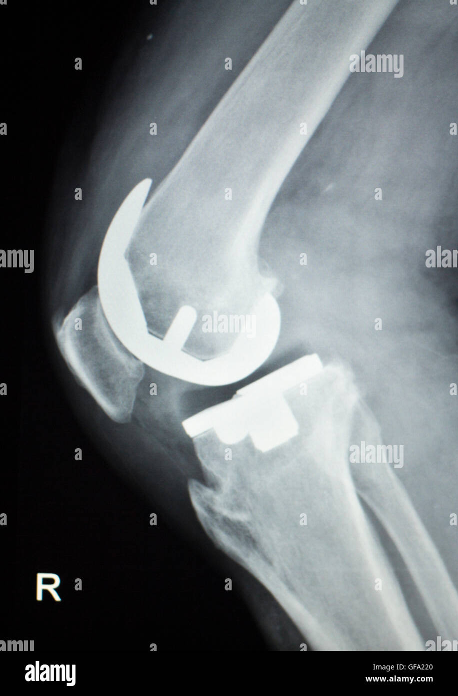 Knie Gelenkersatz orthopdische Titan Metall Traaumatology Kugelgelenk  Implantat Rntgenbild Alter Patienten Stockfotografie - Alamy