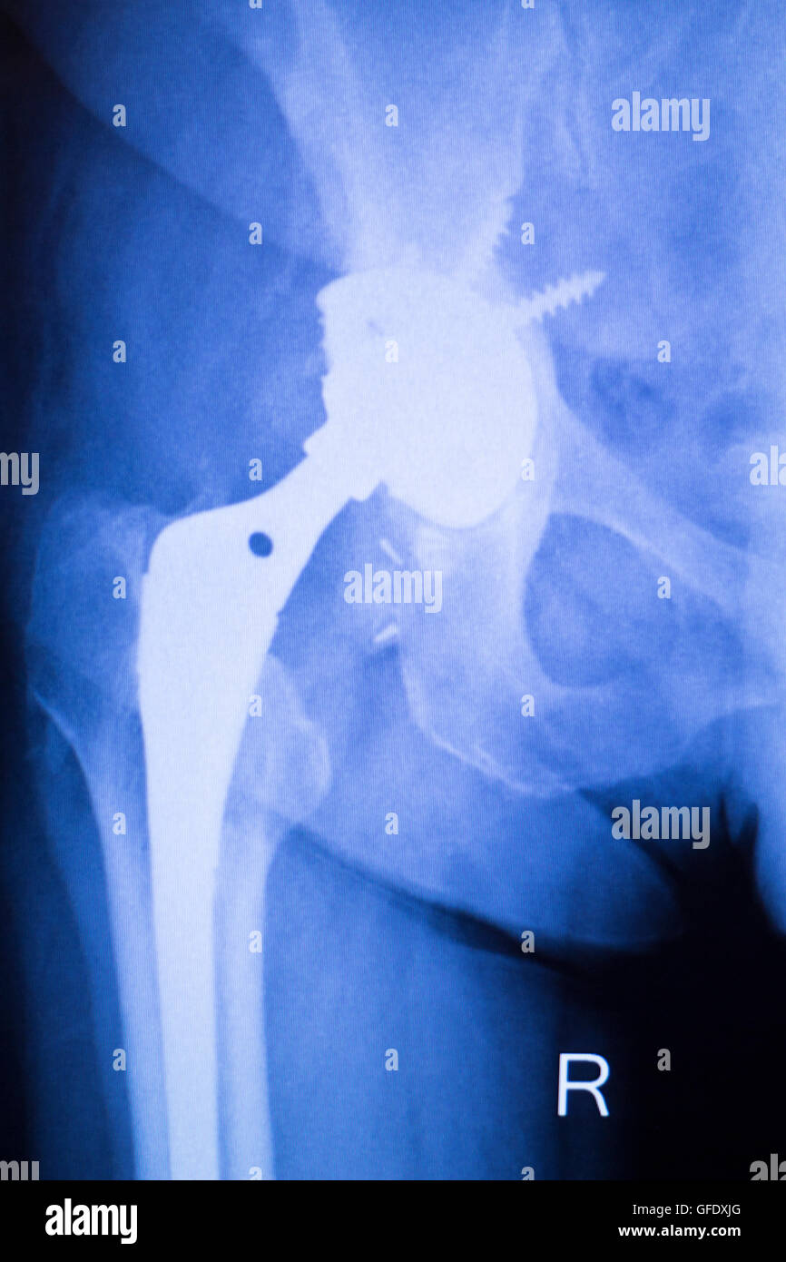 Hüftgelenk Ersatz orthopädische TitanMetall Traaumatology Kugel und Buchse Implantat Röntgen