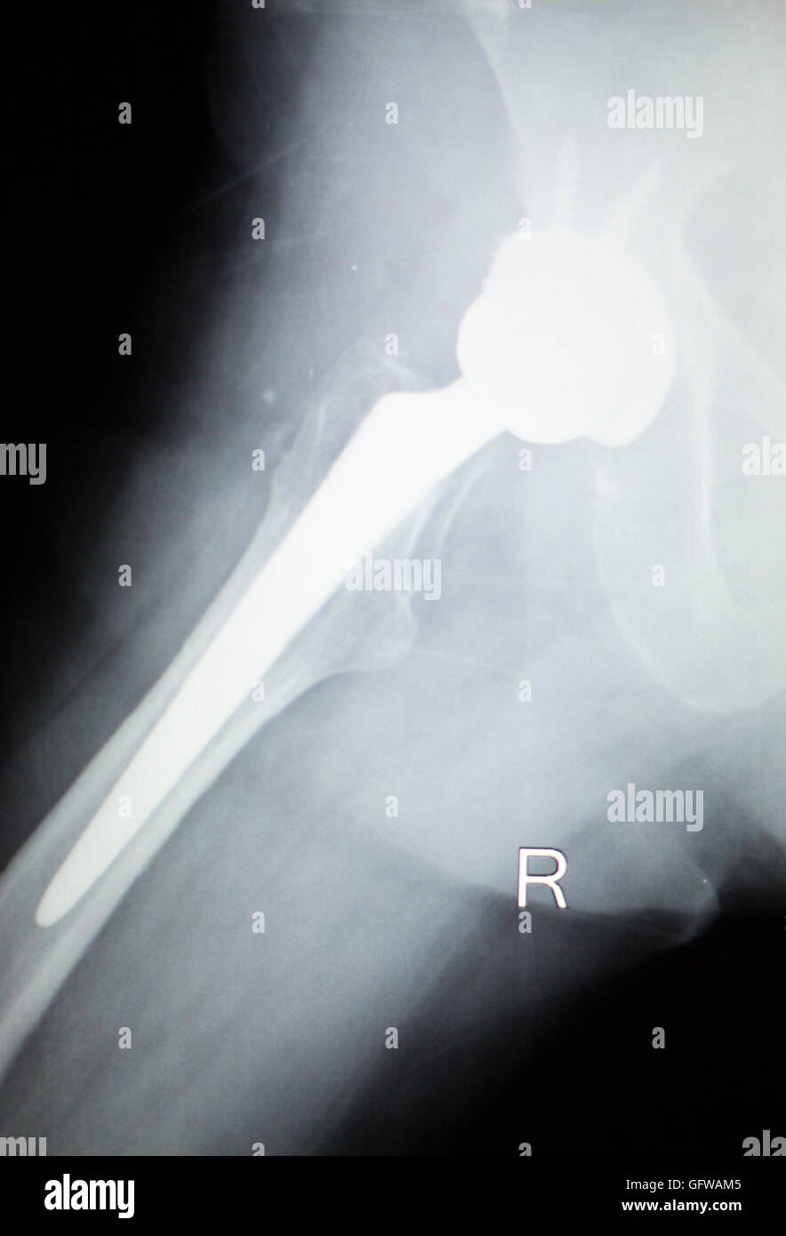 Hüftgelenk Ersatz orthopädische TitanMetall Traaumatology Kugel und Buchse Implantat Röntgen