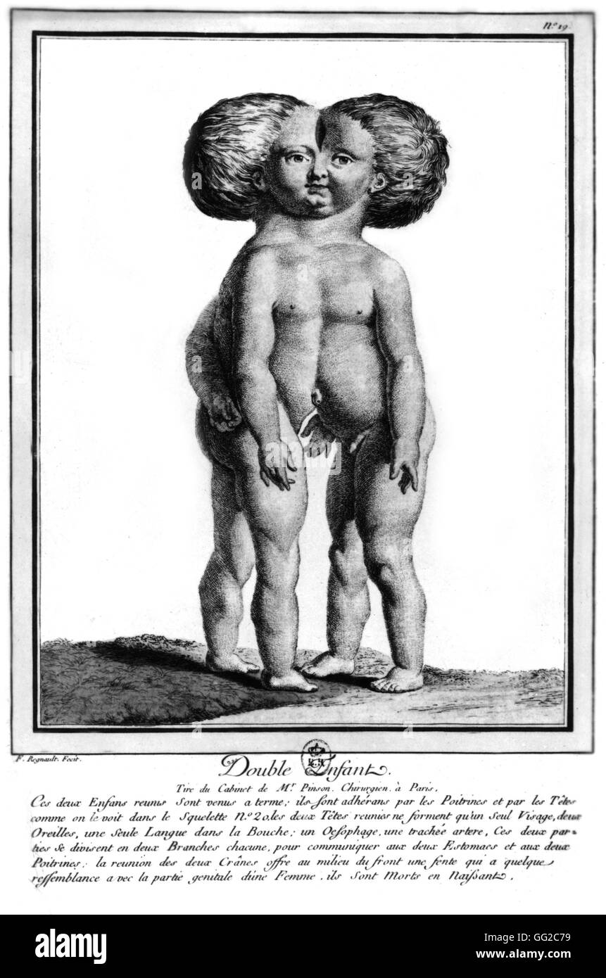 Siamesische Kinder 1775 Kupferstich von Regnault Paris. Bibliothèque nationale Stockfoto