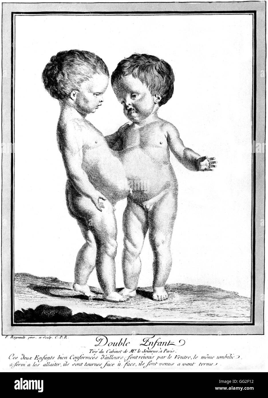 Siamesische Zwillinge, Kupferstich von Regnault 1775 Paris. Bibliothèque nationale Stockfoto