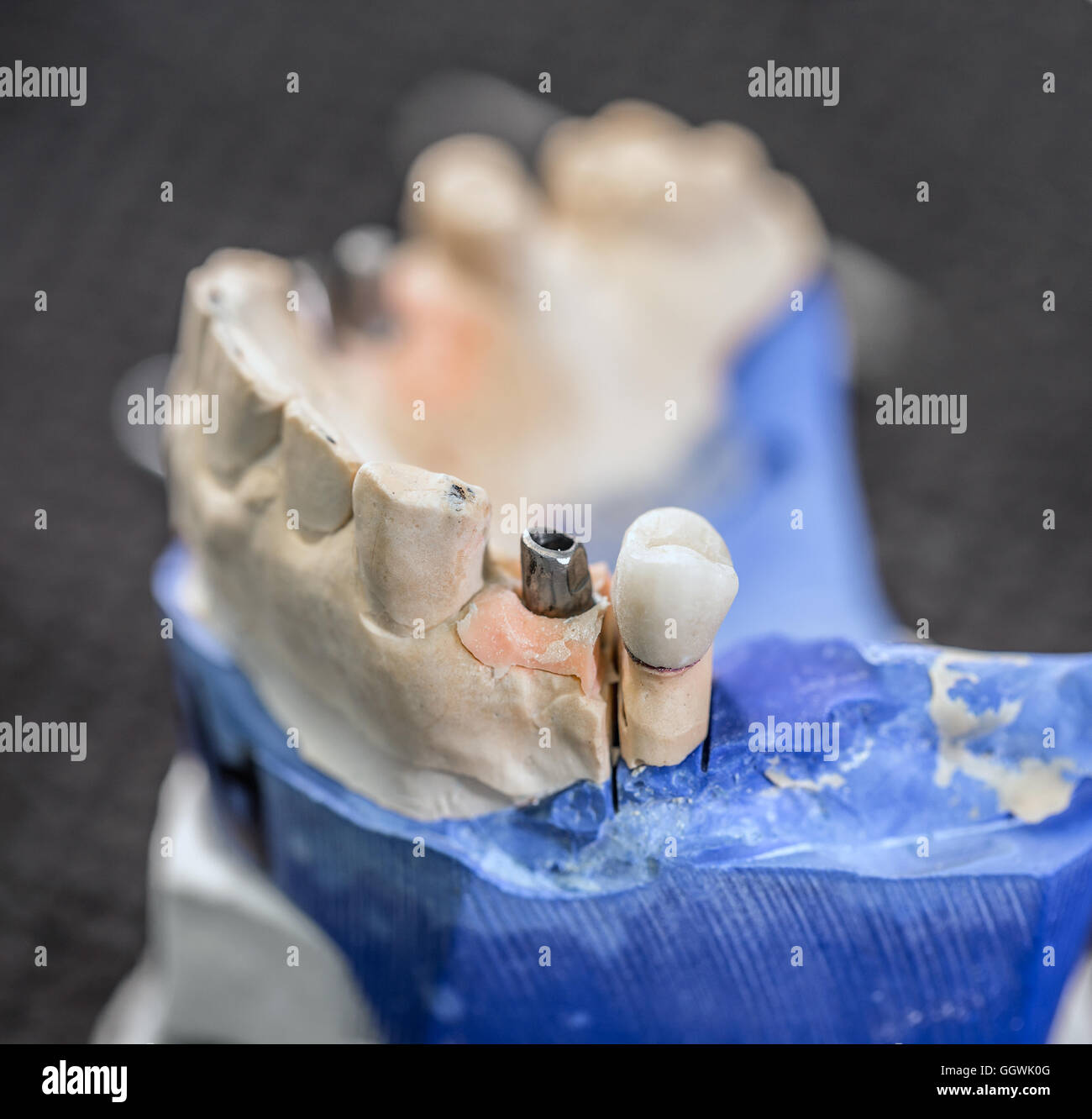 Falsche Zähne auf Gips Kiefer Stockfoto