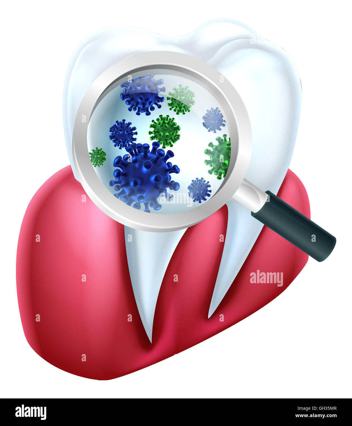 Eine zahnärztliche medizinische Illustration von einem Zahn und Zahnfleisch bedeckt in Bakterien, die durch eine Lupe betrachtet Stockfoto