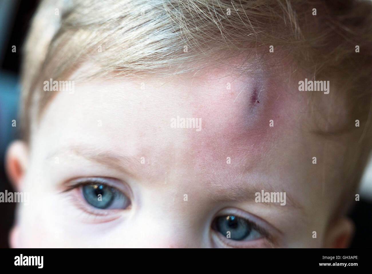 Junge mit Kopfverletzung Stockfoto