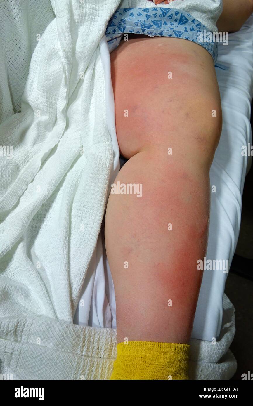 Weibliche Patienten mit tiefen Venenthrombosen sowie Zellulitis im linken Bein. Stockfoto