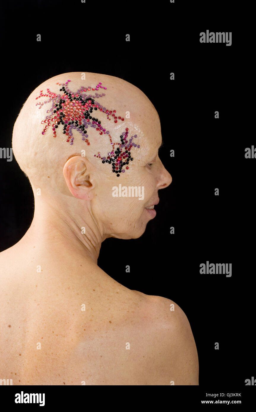 Frau, die ihre Haare verloren hat, nach der Therapie den Kopf mit einem Bild des Gens hergestellt aus Kristallen verziert. Stockfoto