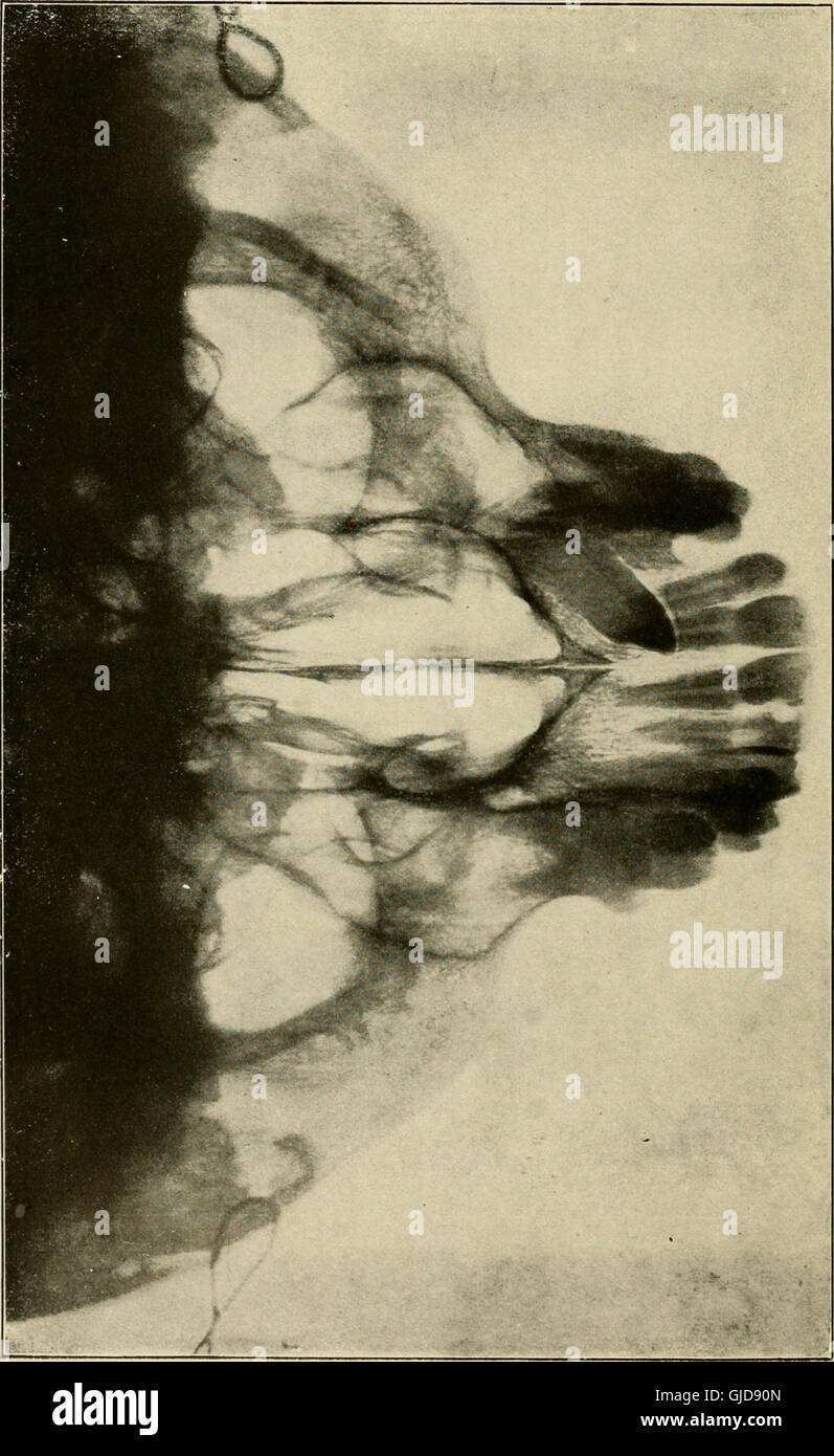 Grund- und dental Radiographie - von Howard Riley Raper (1918) Stockfoto