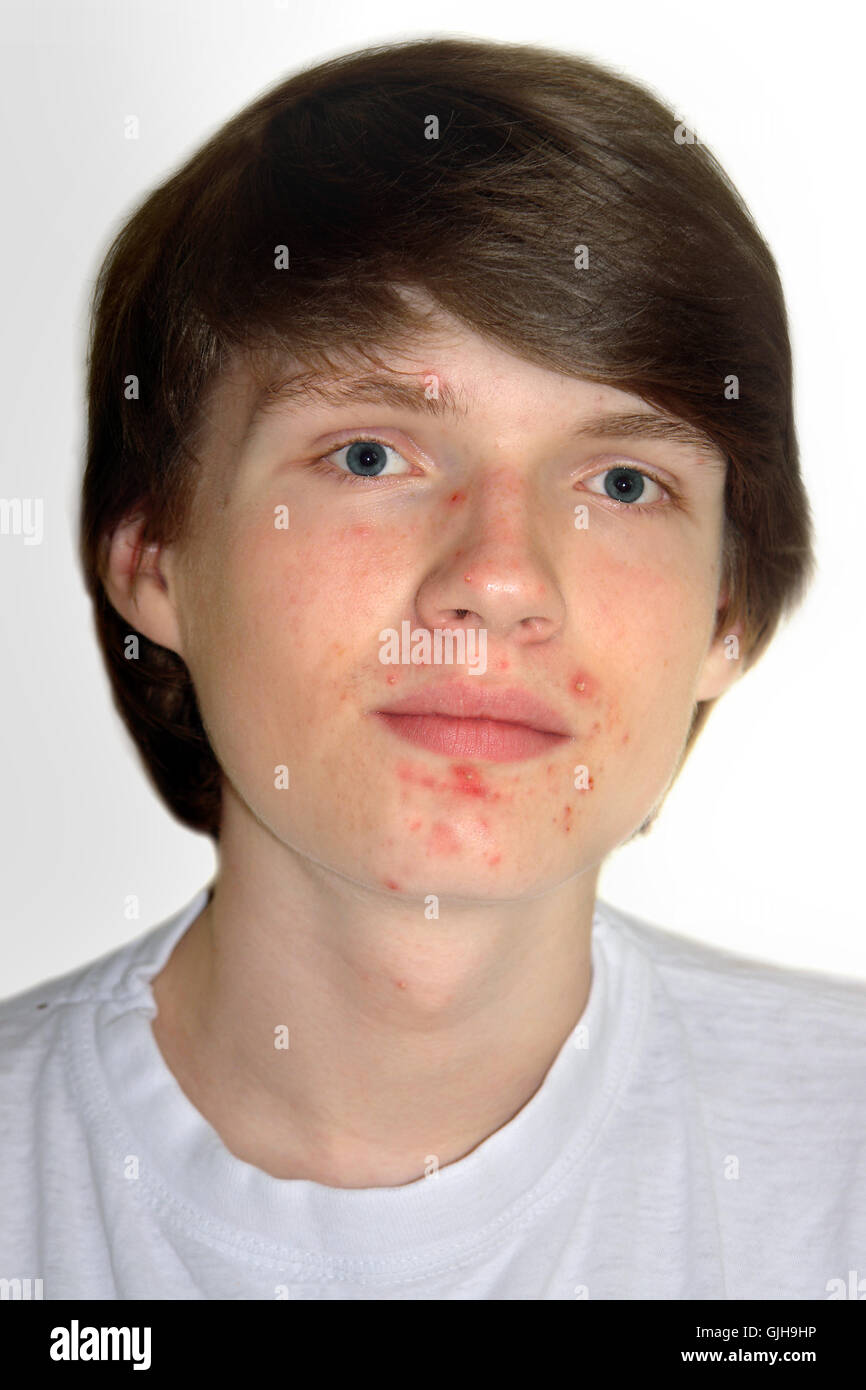 Teen mit Akne Stockfoto