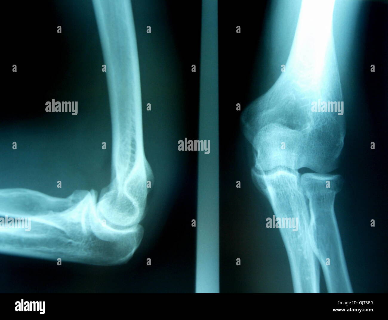 Röntgenbild eines menschlichen Arms Stockfoto