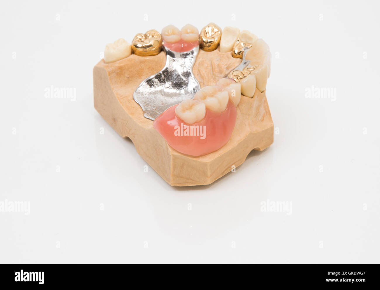 anspruchsvollen Zahnersatz Stockfoto