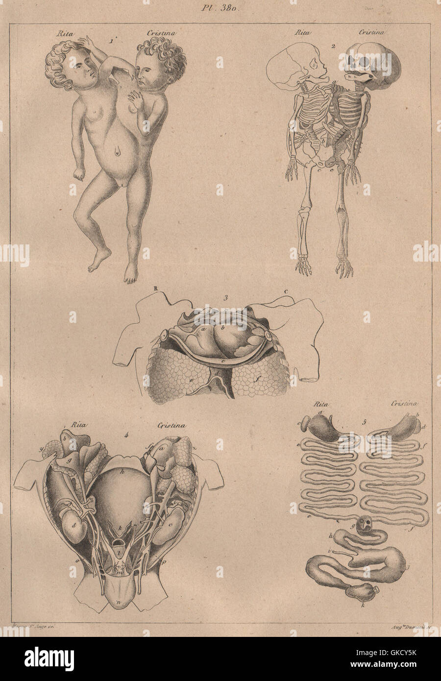 Siamesische Zwillinge: 'Monstruosités' II. Siamesische Zwillinge, antiken Drucken 1834 Stockfoto